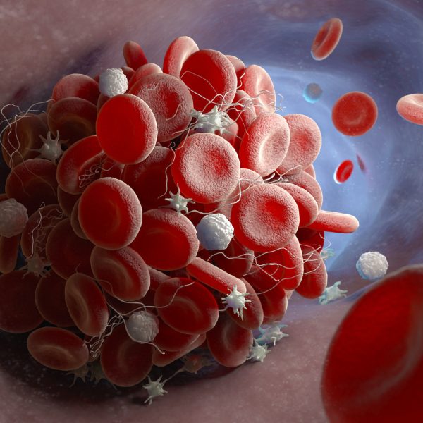 Formation of a blood clot Depiction of a blood clot forming inside a blood vessel. 3D illustration